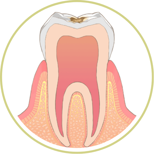 虫歯C1