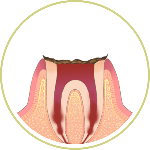 虫歯C4