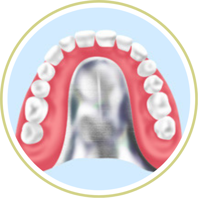 コバルトクロム床義歯