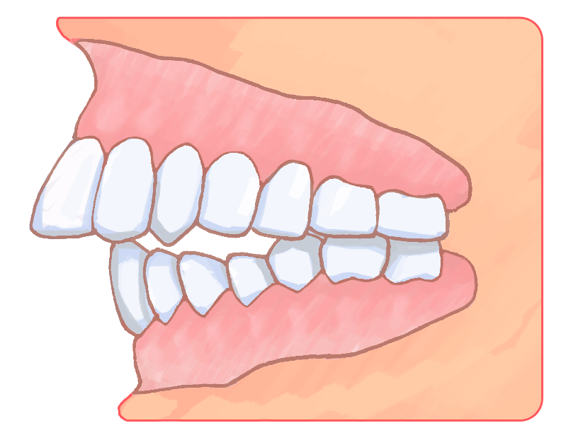 上顎前突イラスト