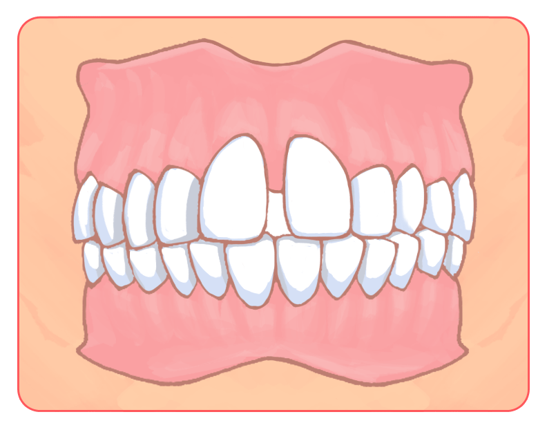 空隙歯列イラスト